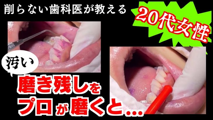 歯磨きで汚い磨き残しがあると歯周病は治りません。プロが磨くとこうなります。歯周病リスクを下げ、虫歯を予防するためには歯磨き上手になりましょう。